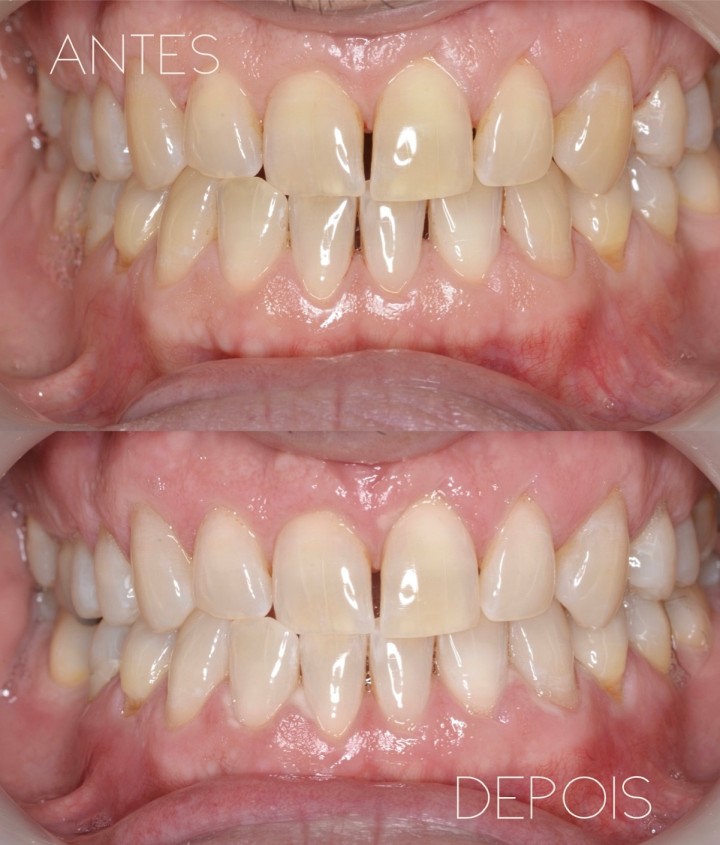 Branqueamento Dentário e Higiene Oral