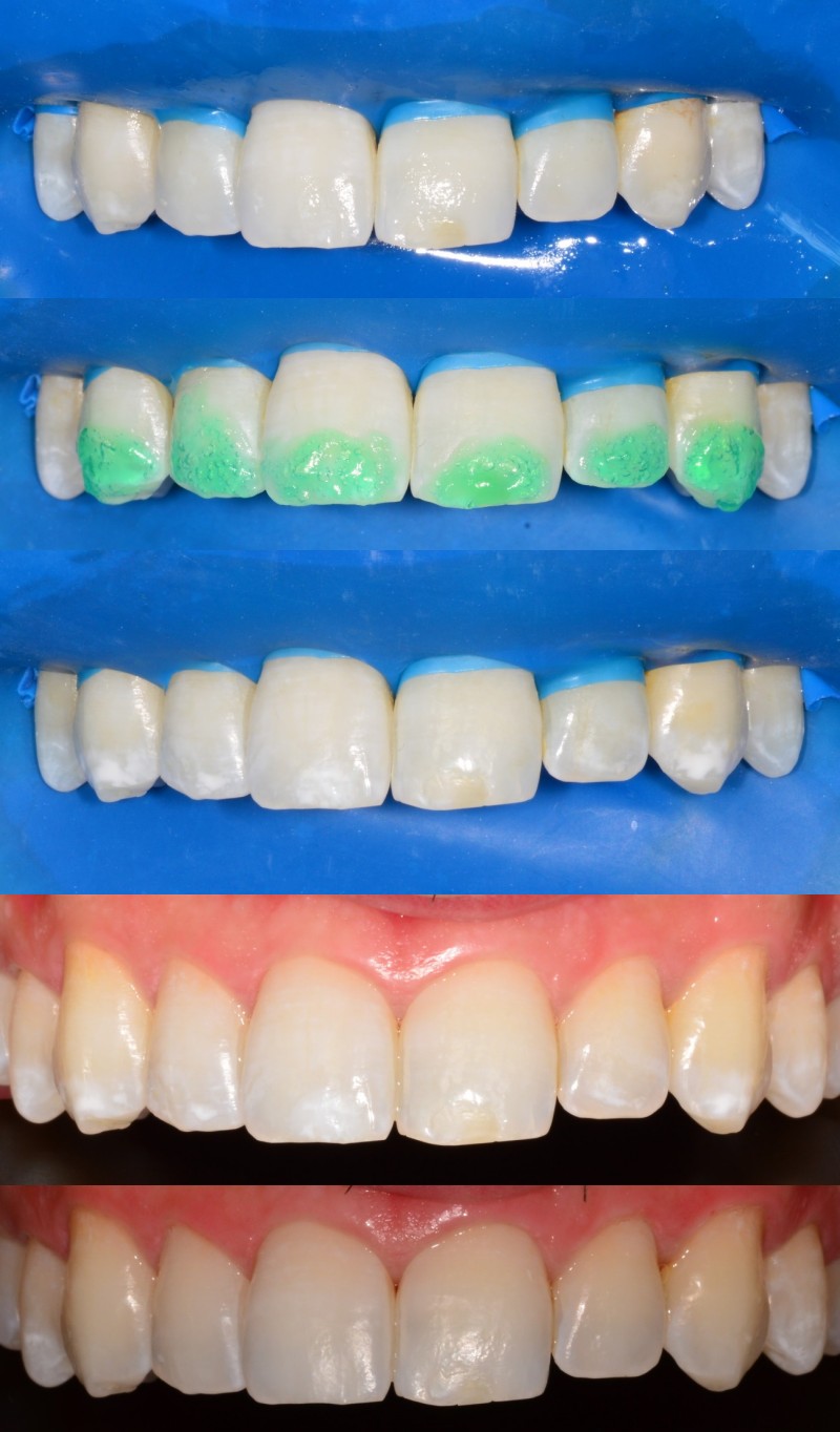 Dentisteria Conservadora Minimamente Invasiva