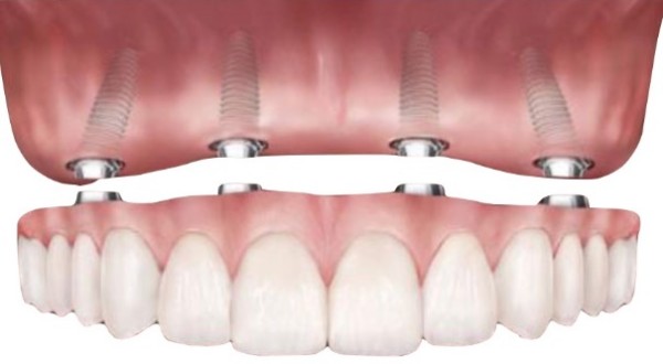 Implantes Dentários