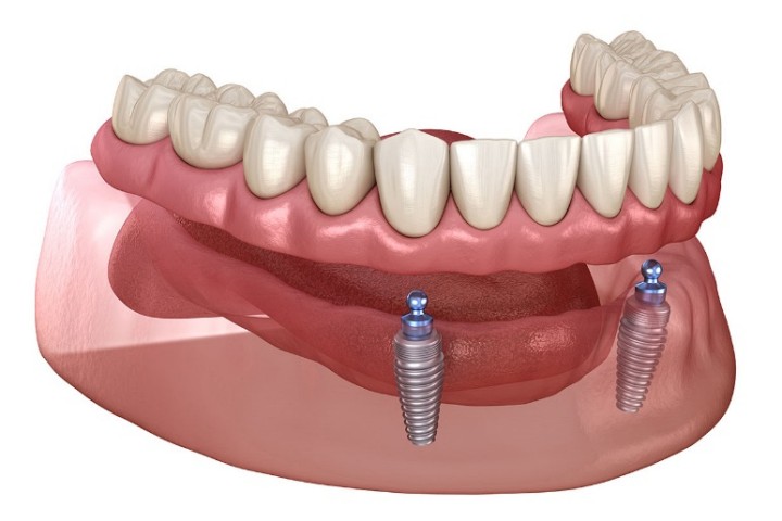 Implantes Dentários